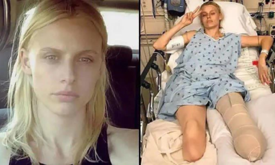 American model loses legs and almost dies despite proper tampo