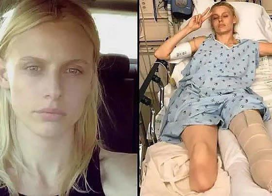 American model loses legs and almost dies despite proper tampo