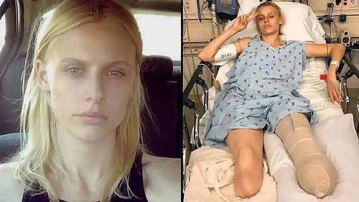 American model loses legs and almost dies despite proper tampo